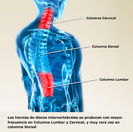 Infografia - Hernia Cervical Lumbar