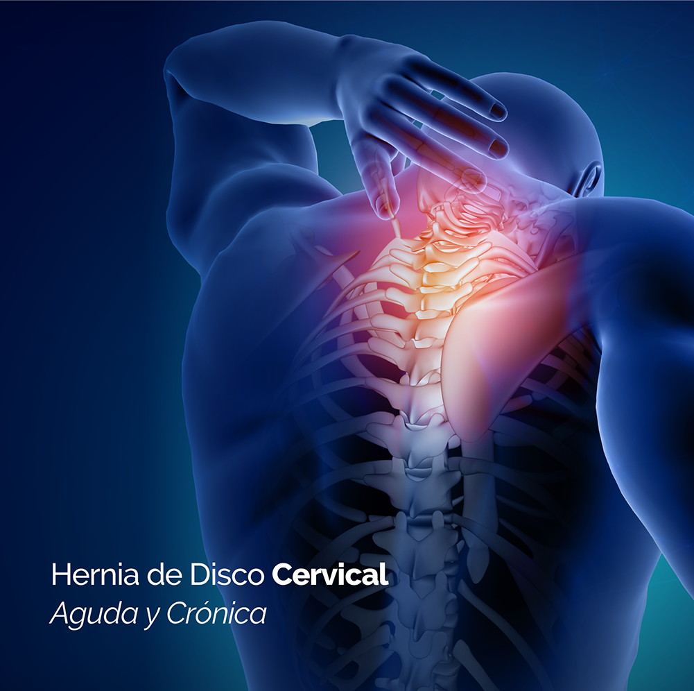 Recupere su hernia de disco cervical sin cirugía