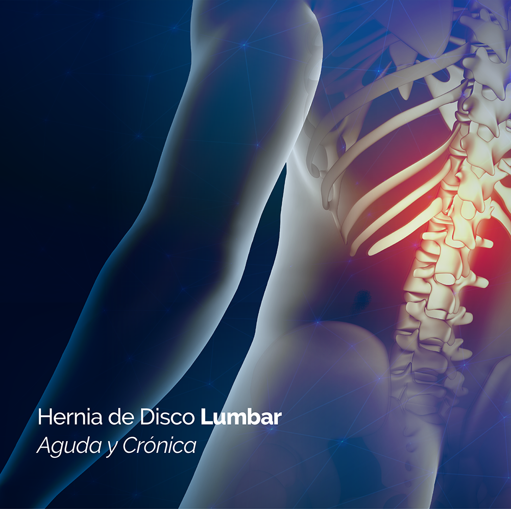 Recupere su hernia de disco lumbar sin cirugía